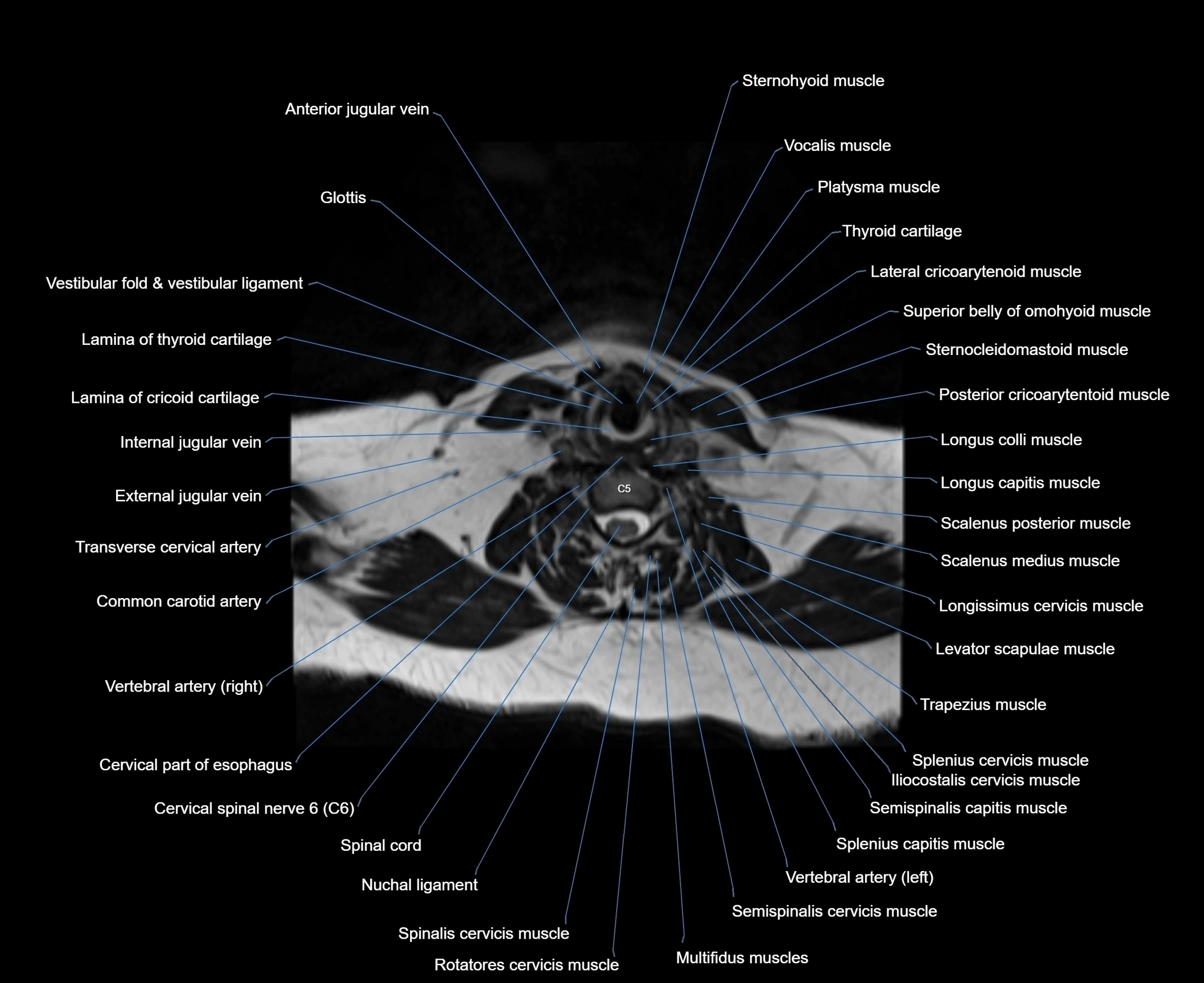 MRI Neck 3D labelled cross section anatomy axial 3t image-00001-00063.webp